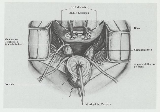 Medizinische Zeichnung: Abtrennung Prostata, von 1991